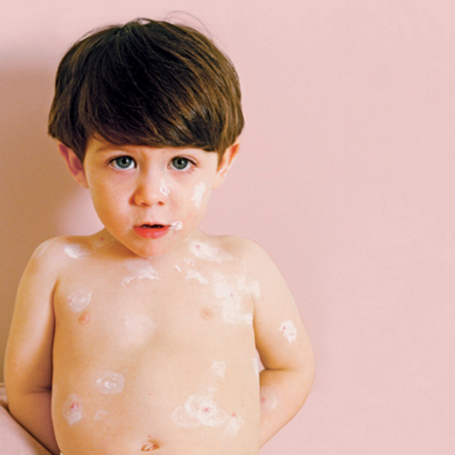 What to do if your kid gets hives