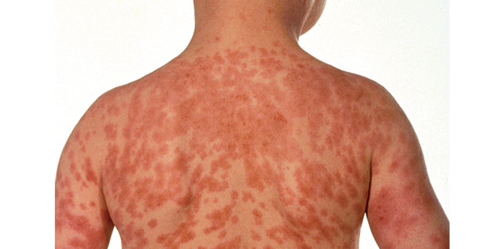 10 Common Rashes On Kids With Photos Symptoms And Treatment