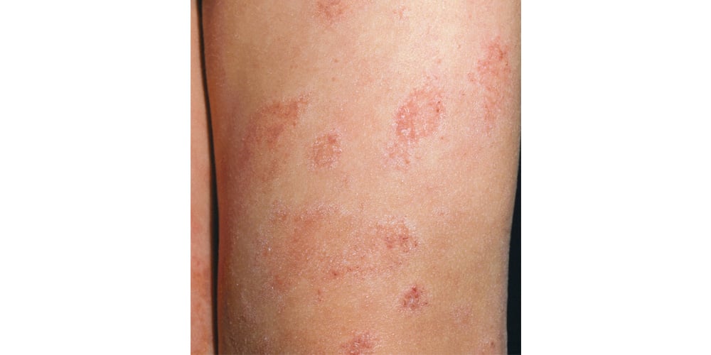 10 Common Rashes On Kids With Photos Symptoms And Treatment