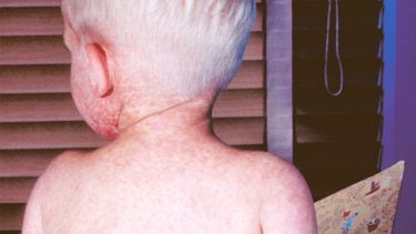 This photograph depicts the back of a boy with measles, which was captured on the third day of its characteristic rash.