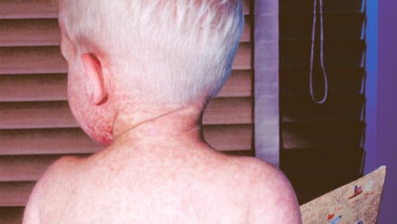 This photograph depicts the back of a boy with measles, which was captured on the third day of its characteristic rash.