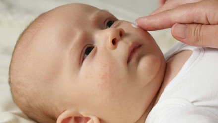 A mom spreading moisturizing cream on her baby's rash on her face