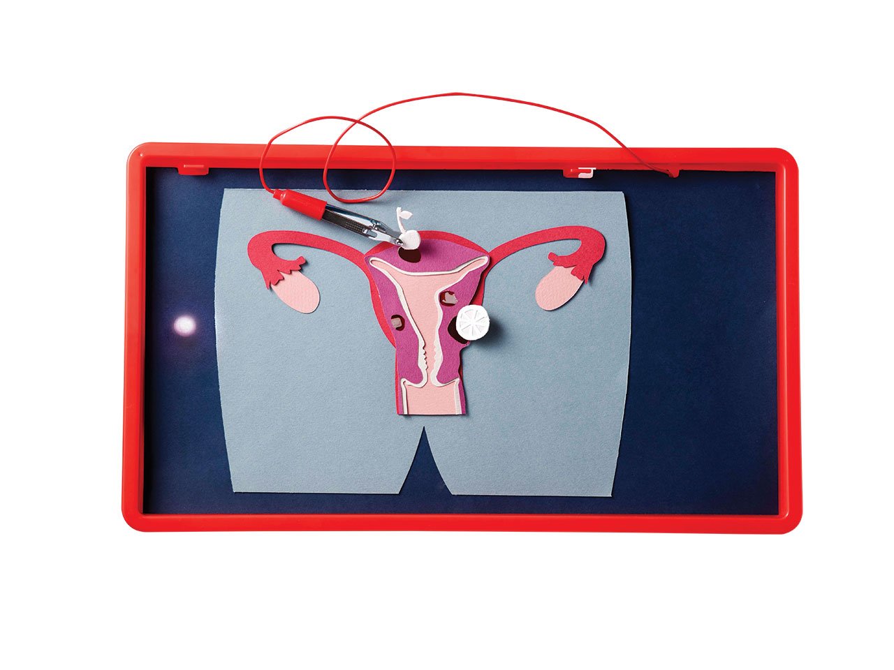 Paper illustration of uterine fibroids 