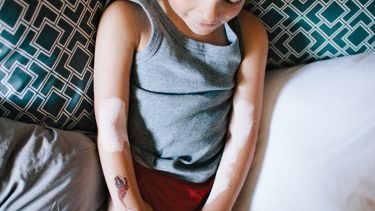 Kid with mosquito bites on arms