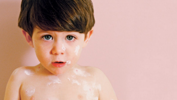 Child with splotchy, rashy skin