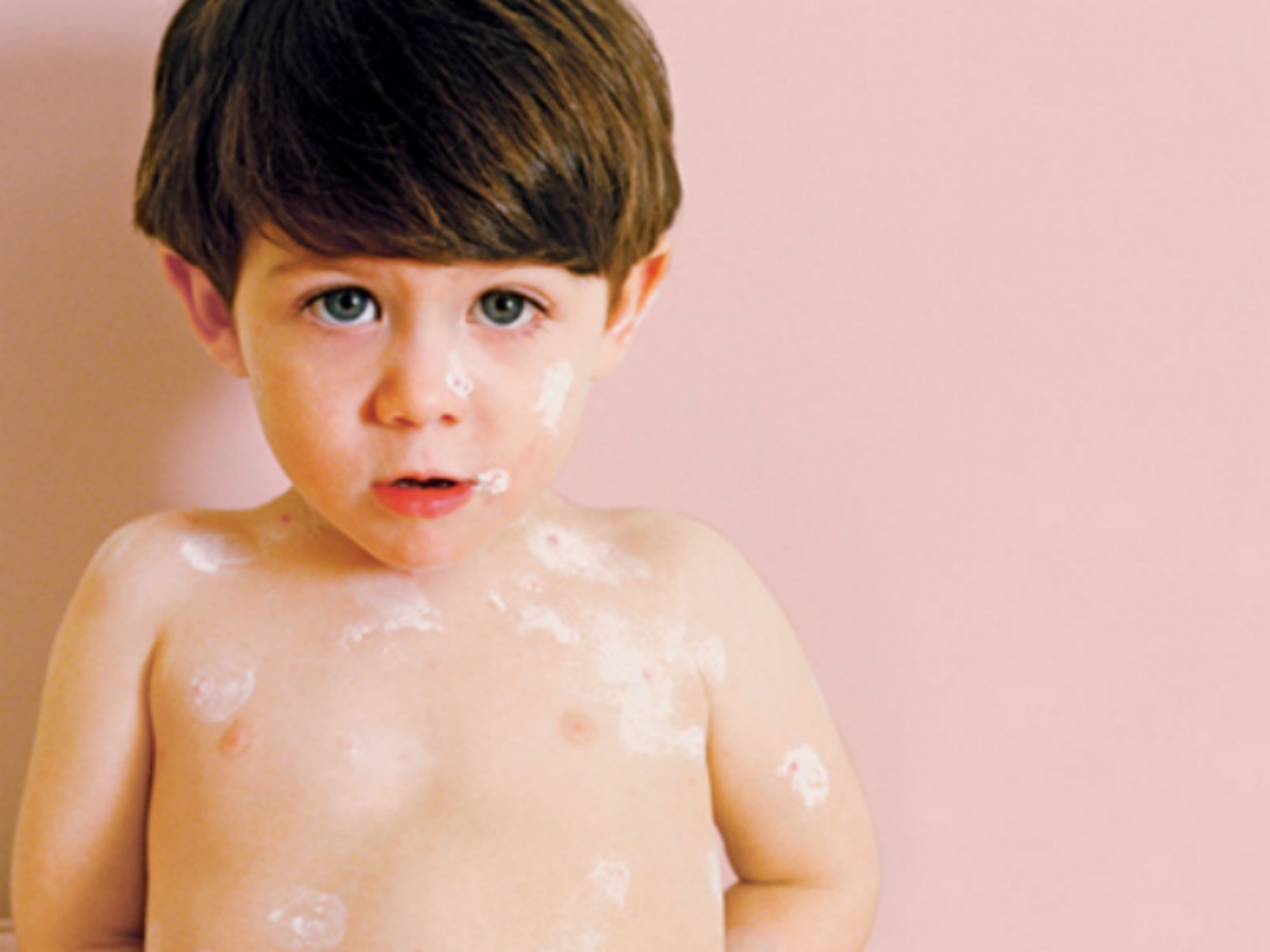 Child With Splotchy Rashy Skin