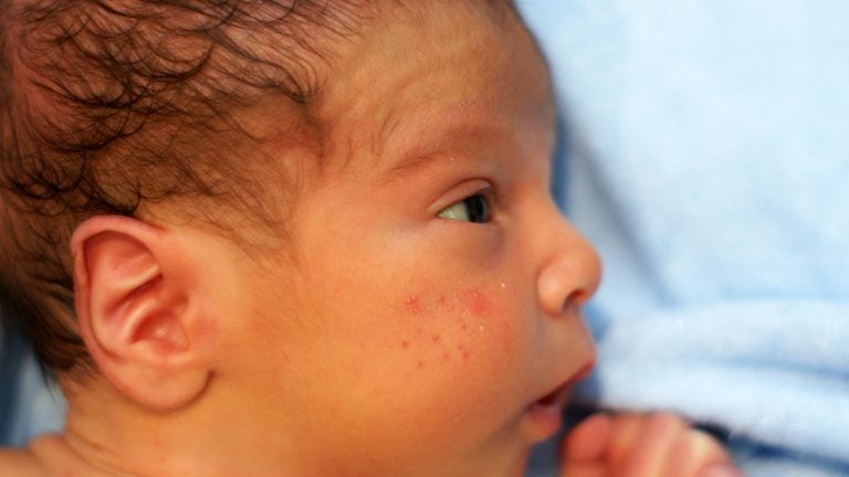 Baby acne FAQ Symptoms, treatment and different types