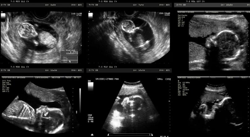 Series of fetal ultrasound images