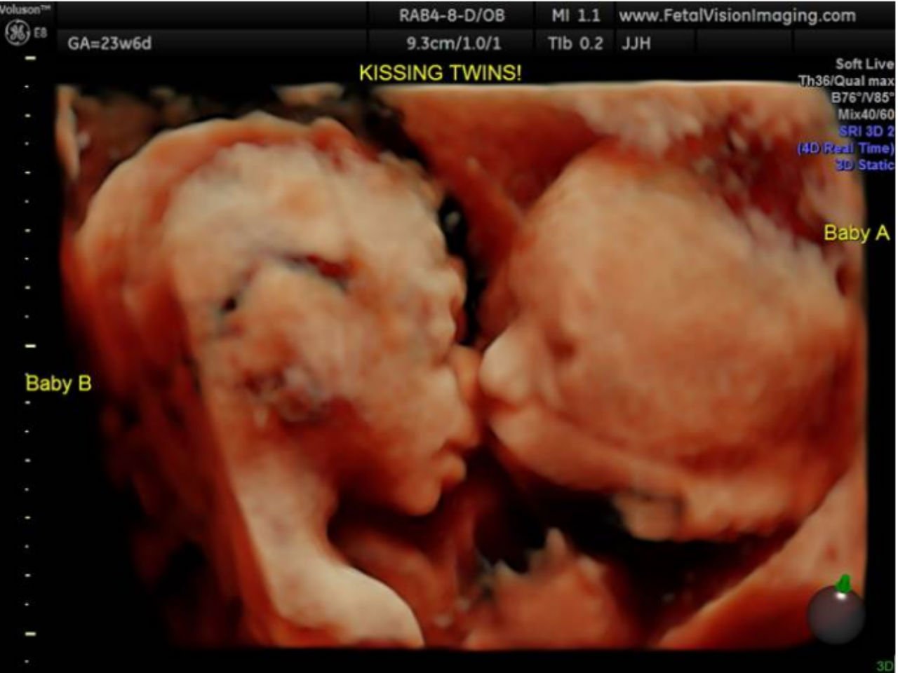 ultrasound image of twins kissing in the womb