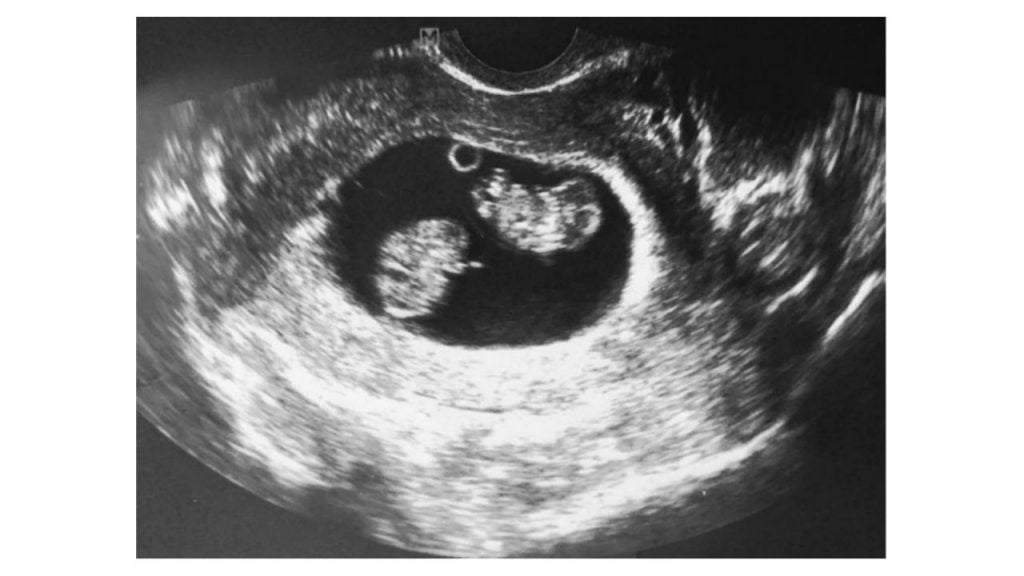 jessi's ultrasound showing her twins' heartbeats