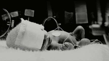 A preemie baby lying in the NICU