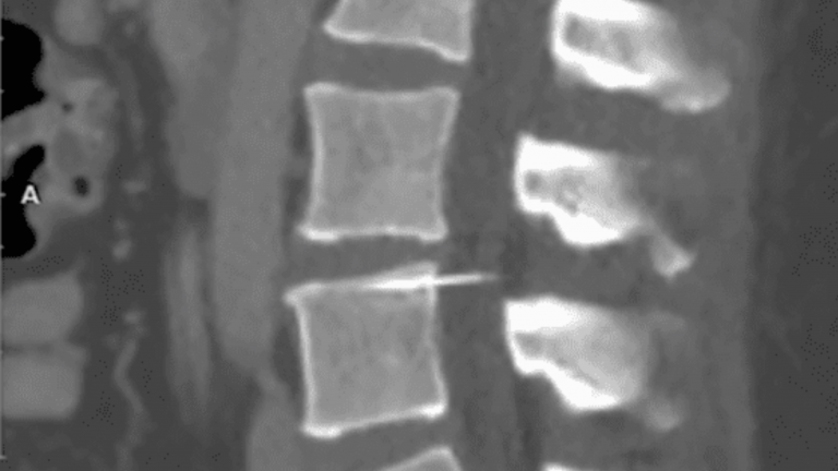 CT scan of woman's spine with a needle in it