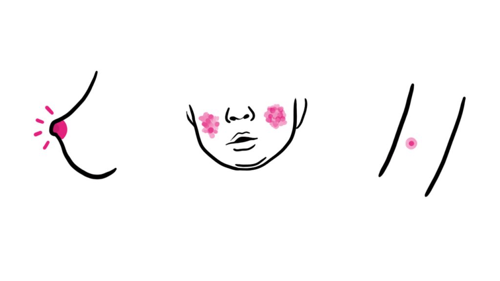 Illustration of a boob with a sore nipple, a baby's face with eczema, and an arm with a bug bite