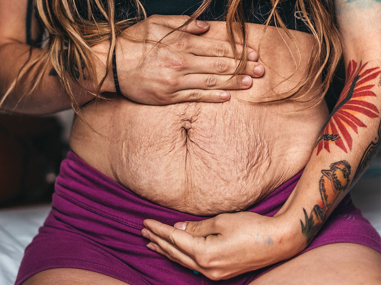 Is body positivity and shining the spotlight on scars, stretch marks