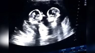 ultrasound of twins fighting in the womb