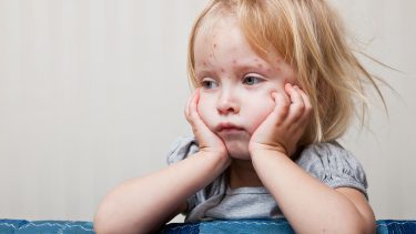 little girl with chicken pox