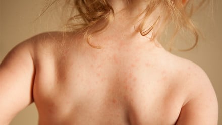Girl with hives on her arms and back