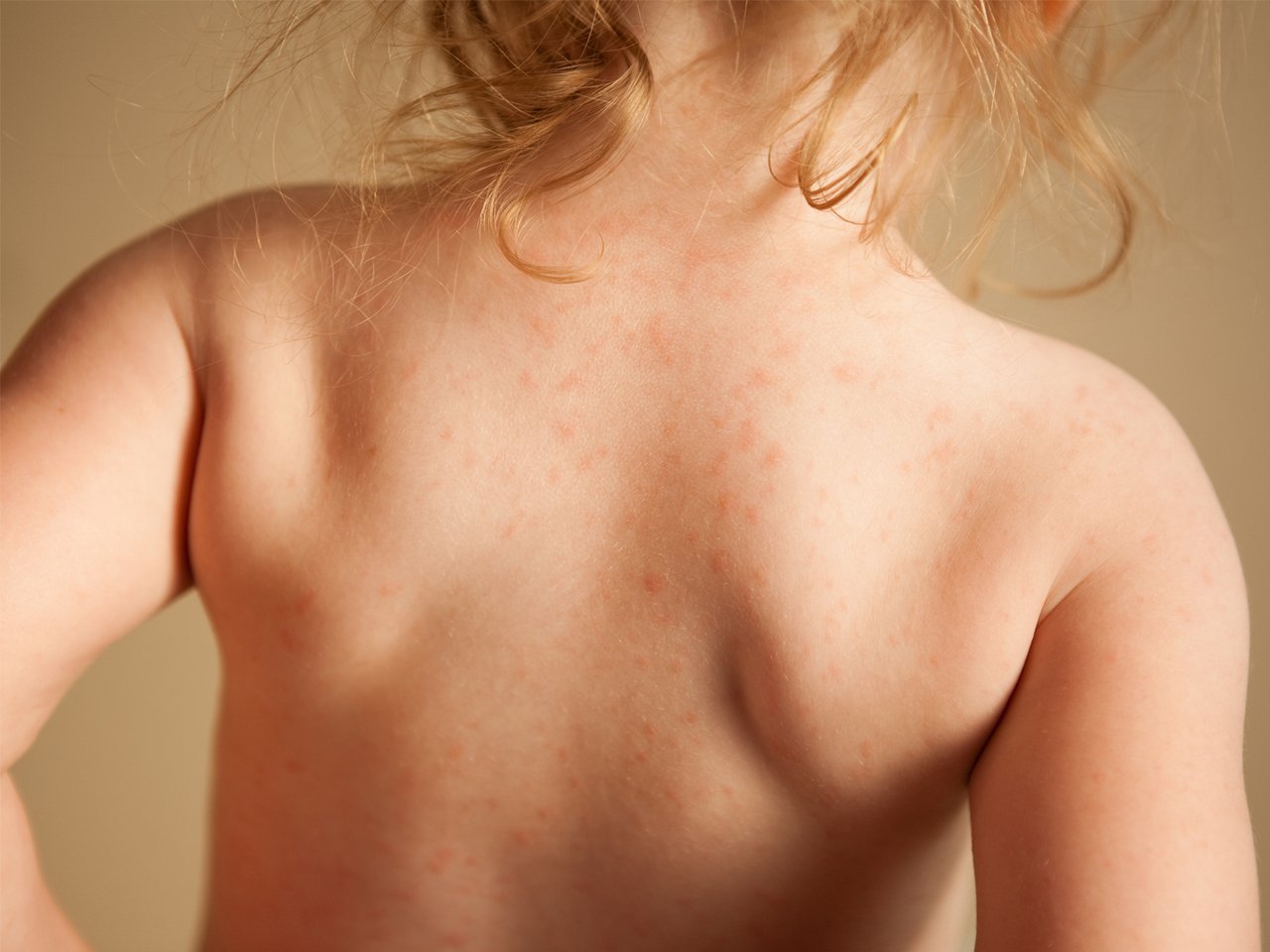Severe food allergies in children