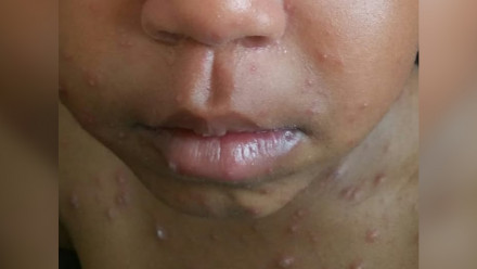 close up of a black kid's mouth showing chicken pox