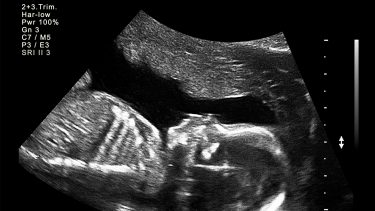 20-week ultrasound: Ultrasound photo