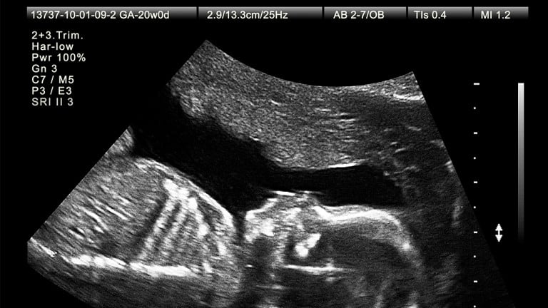 New Baby Scan Frame Pregnancy Pregnant Ultrasound 12 20 Week First Photo Picture