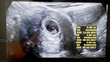 Six-week ultrasound: Ultrasound photo