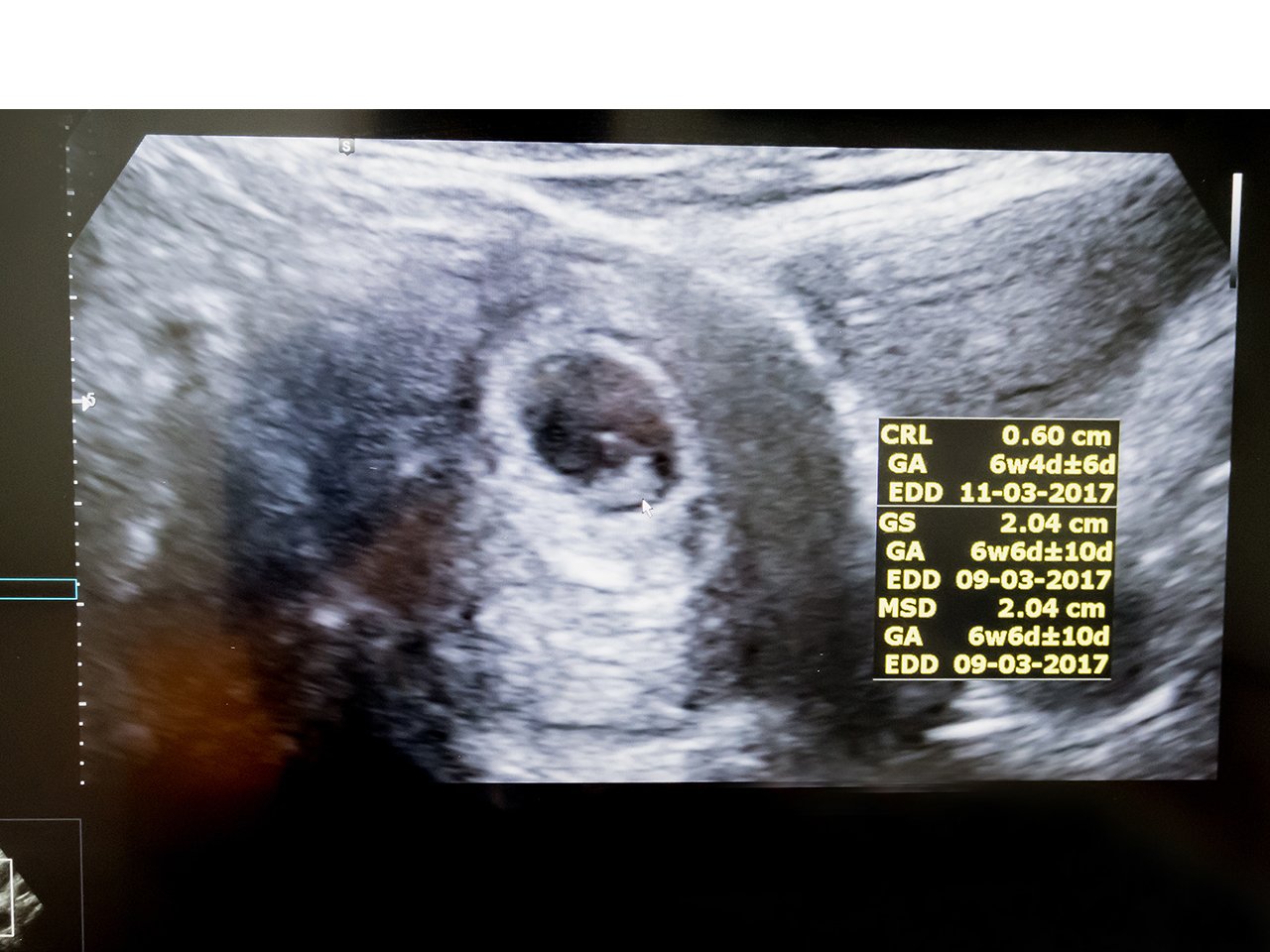 Normal first trimester ultrasound