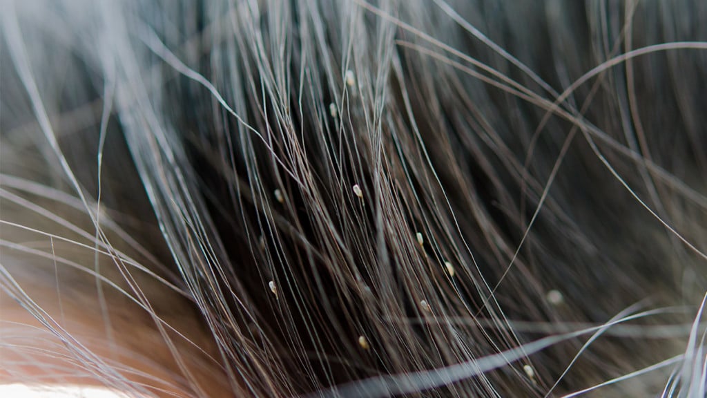 Nits (or louse egg) in the hair