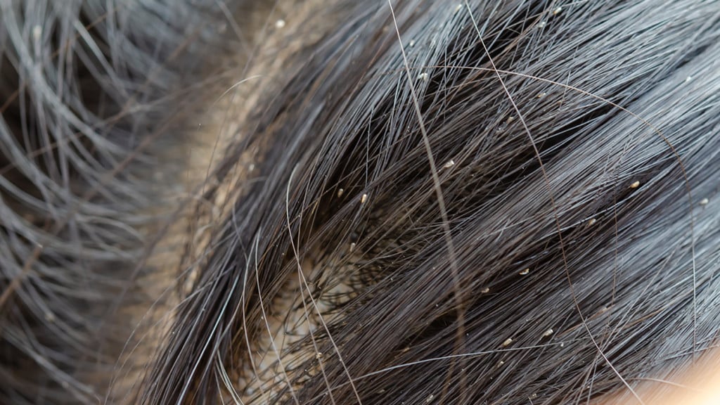 Lice in dark hair