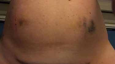 amy schumer's c-section scar on her belly