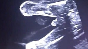 A photo of an ultrasound showing a fetus urinating while in utero.